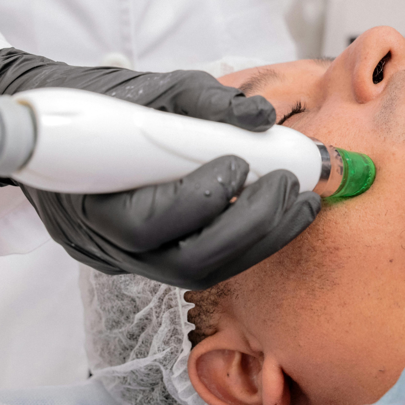 laser hair removal